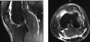 Resonancia magnética de rodilla izquierda sin contraste