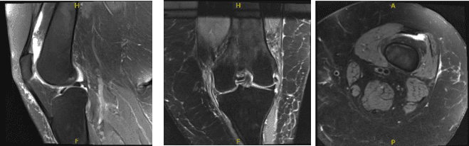 MRI Left Knee non-contrast