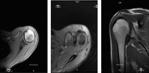 MRI Left shoulder non-contrast