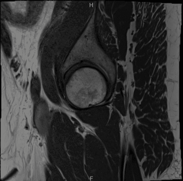 MRI Right hip non-contrast