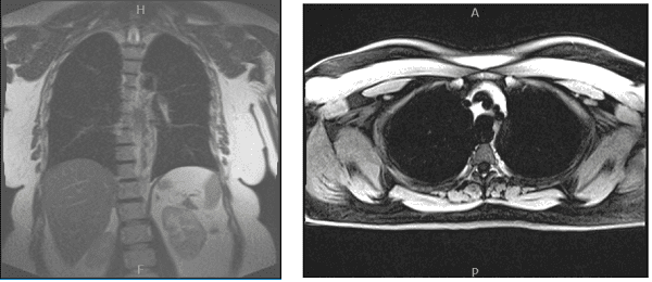 MRI chest without and with contrast