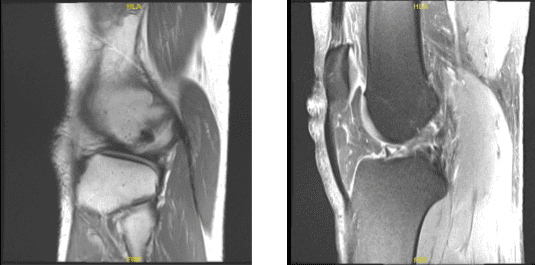 MRI right knee non-contrast