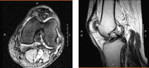 Magnetic resonance imaging of the left knee