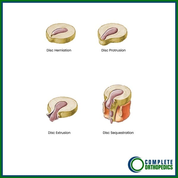 Disc Rupture Classification Illustrated