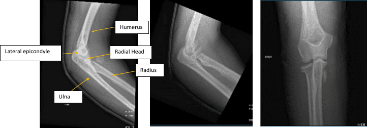 Figure 1. AP Oblique and Flexion Lateral Projection of Right Elbow