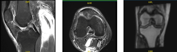 MRI Right Knee Non-contrast