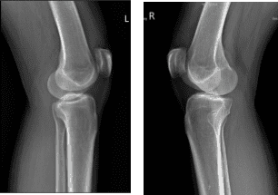 X-ray Bilateral Knees 3 views each