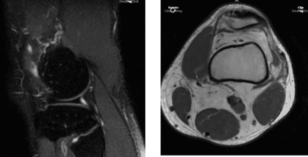 MRI Left Knee Non-contrast