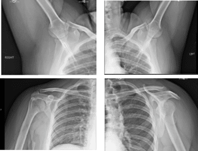 X-ray Bilateral Shoulders