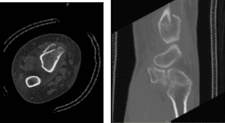 TAC muñeca derecha sin contraste