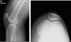 Right knee X-ray complete with Patella