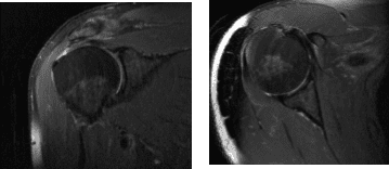MRI Right Shoulder Non-contrast