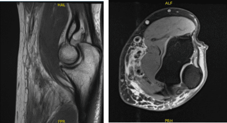 MRI 3T Left Elbow non-contrast