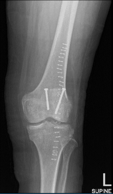 Radiografía de rodilla izquierda AP y lateral