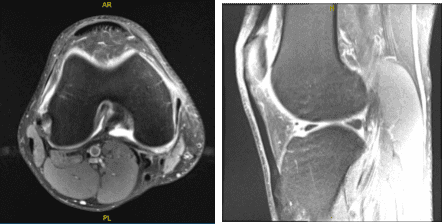 MRI-3T Right Knee non-contrast