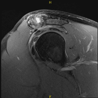 Imágenes de artroscopia intraoperatoria