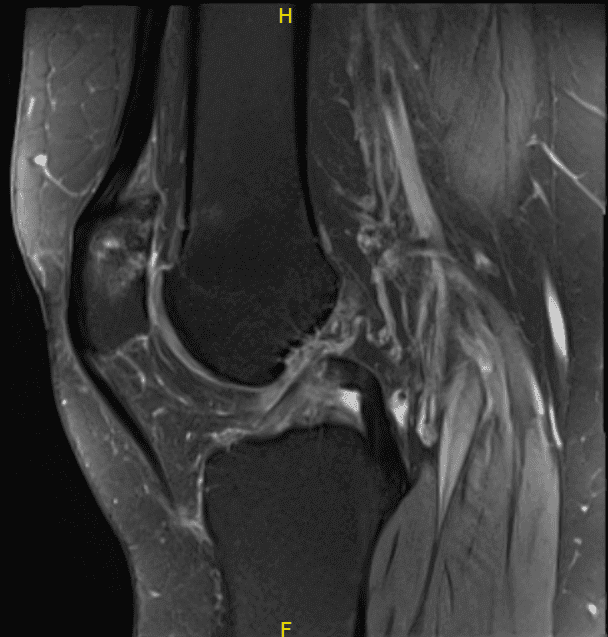MRI-3T Rodilla izquierda sin contraste
