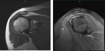 MRI-3T Left Shoulder non-contrast