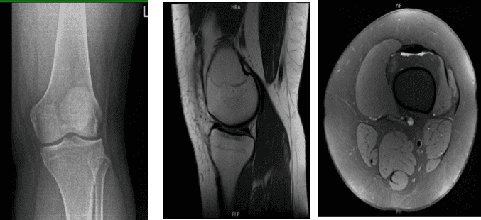 MRI of the left knee