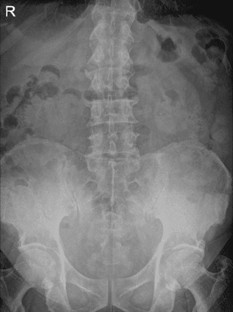 LS Spine X-ray Flex/Ext no obliques