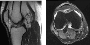 MRI-3T Right knee non-contrast