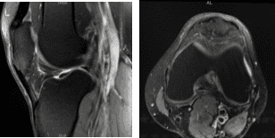 MRI-3T Rodilla Izquierda sin contraste