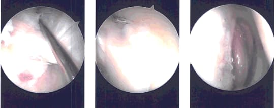 Intraoperative images