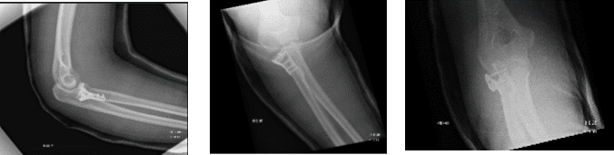 Figure 2. Image of Elbow with 3 cortical screws