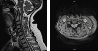 Resonancia magnética de columna cervical sin contraste