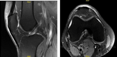 MRI-3t Right Knee non-contrast
