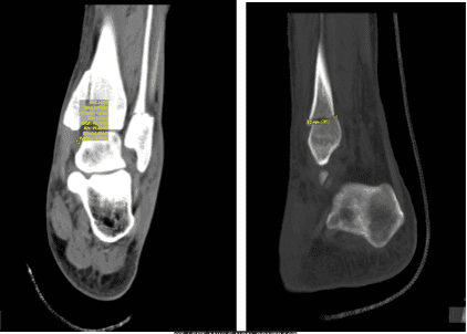 CT-Left ankle non-contrast