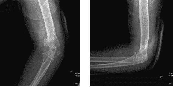 Left elbow X-ray