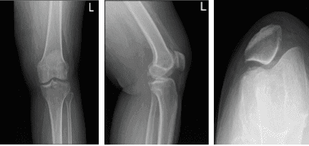 Left knee x-ray complete with patella