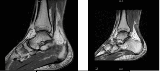 MRI-1.2T Left ankle non-contrast