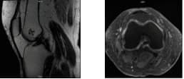 MRI-3T Rodilla derecha sin contraste