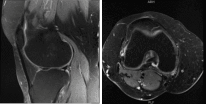 MRI-3T Knee non-contrast