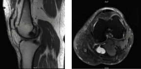 MRI-3T Left knee non-contrast