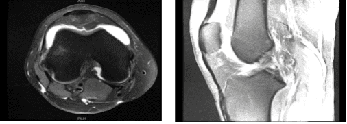 MRI-3T Right knee non-contrast