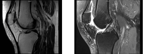 MRI-3T Right knee non-contrast