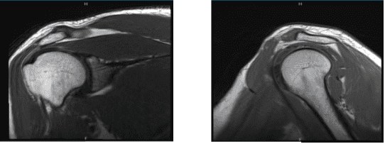 MRI-3T Hombro derecho sin contraste
