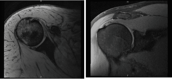 MRI-3T Right shoulder non-contrast