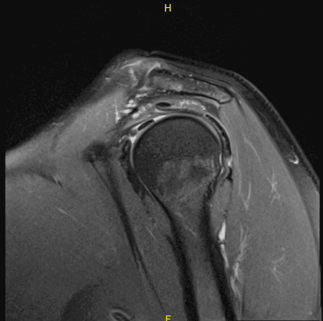 MRI-3T hombro izquierdo sin contraste