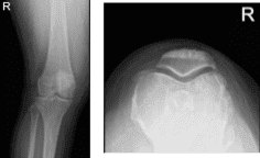 MRI-3T right knee non-contrast