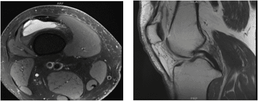 MRI-3T right knee non-contrast