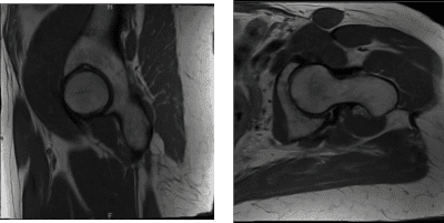 MRI Left hip non-contrast