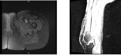 MRI Left thigh non-contrast