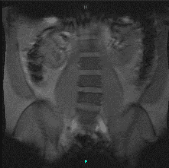 Resonancia magnética de columna lumbar sin contraste