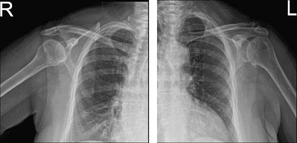 MRI of Left and Right Shoulder
