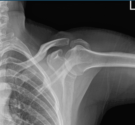 Resonancia magnética del hombro izquierdo