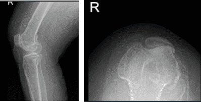 Resonancia magnética de la rodilla derecha